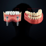 most na 4 implantach